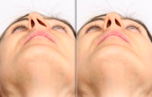 Septoplastyka nosa