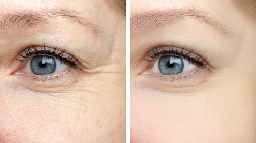 Botoks przed i po - Efekty po zastosowaniu botoksu w okolice oczu