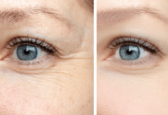 Efekty zabiegu usuwania zmarszczek przy oczach Botoksem - Derm Estetyka
