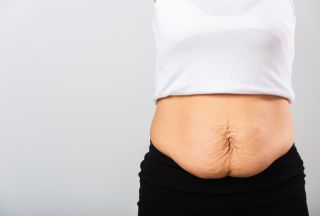 Operacja plastyczna brzucha u kobiet po ciąży