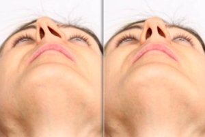 Septoplastyka nosa
